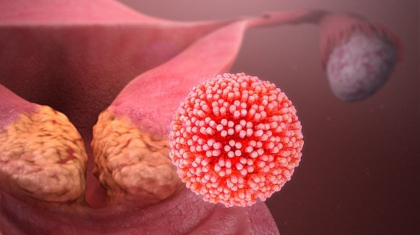 can cervical cancer not be caused by hpv